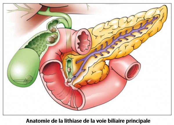 Lithiase